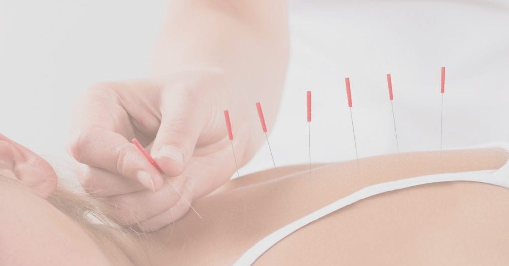 Migraine and Acupuncture