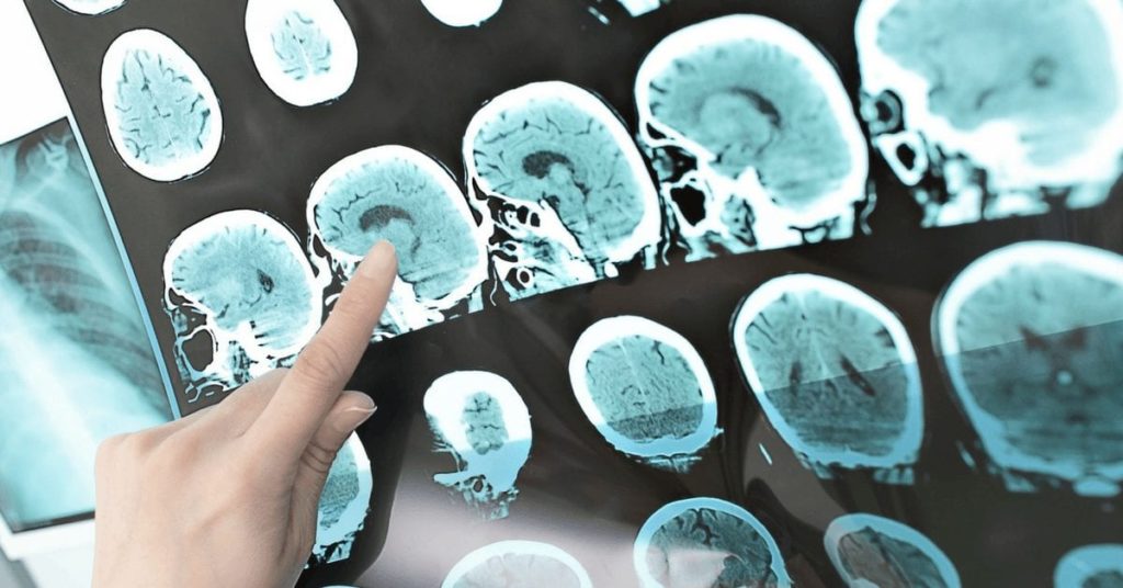 looking for brain lesions on image study