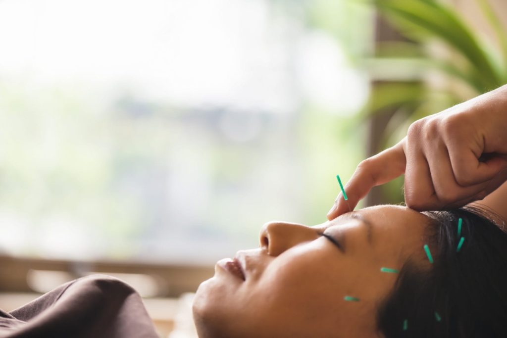Young womanr receiving acupuncture treatment for migraine treatment